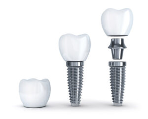 Diagram of a dental post | periodontal and implant surgeons of houston