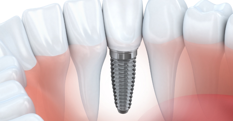 | periodontal and implant surgeons of houston