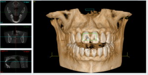 best dental implant houston