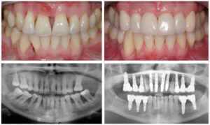 Periodontal-disease-dental-implants