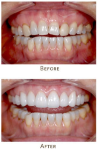 before and after cosmetic dentistry