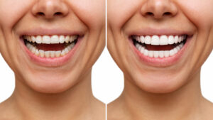 Cosmetic Dentistry Houston TX